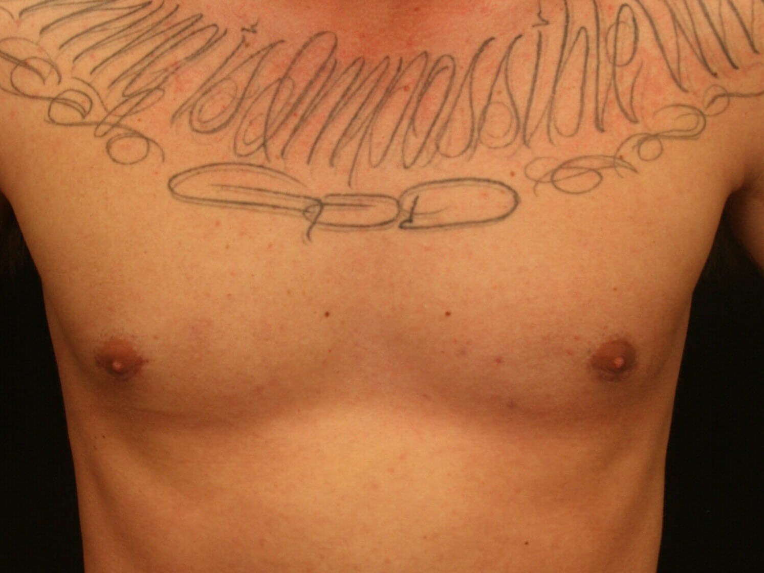 Gynecomastia Before and After After