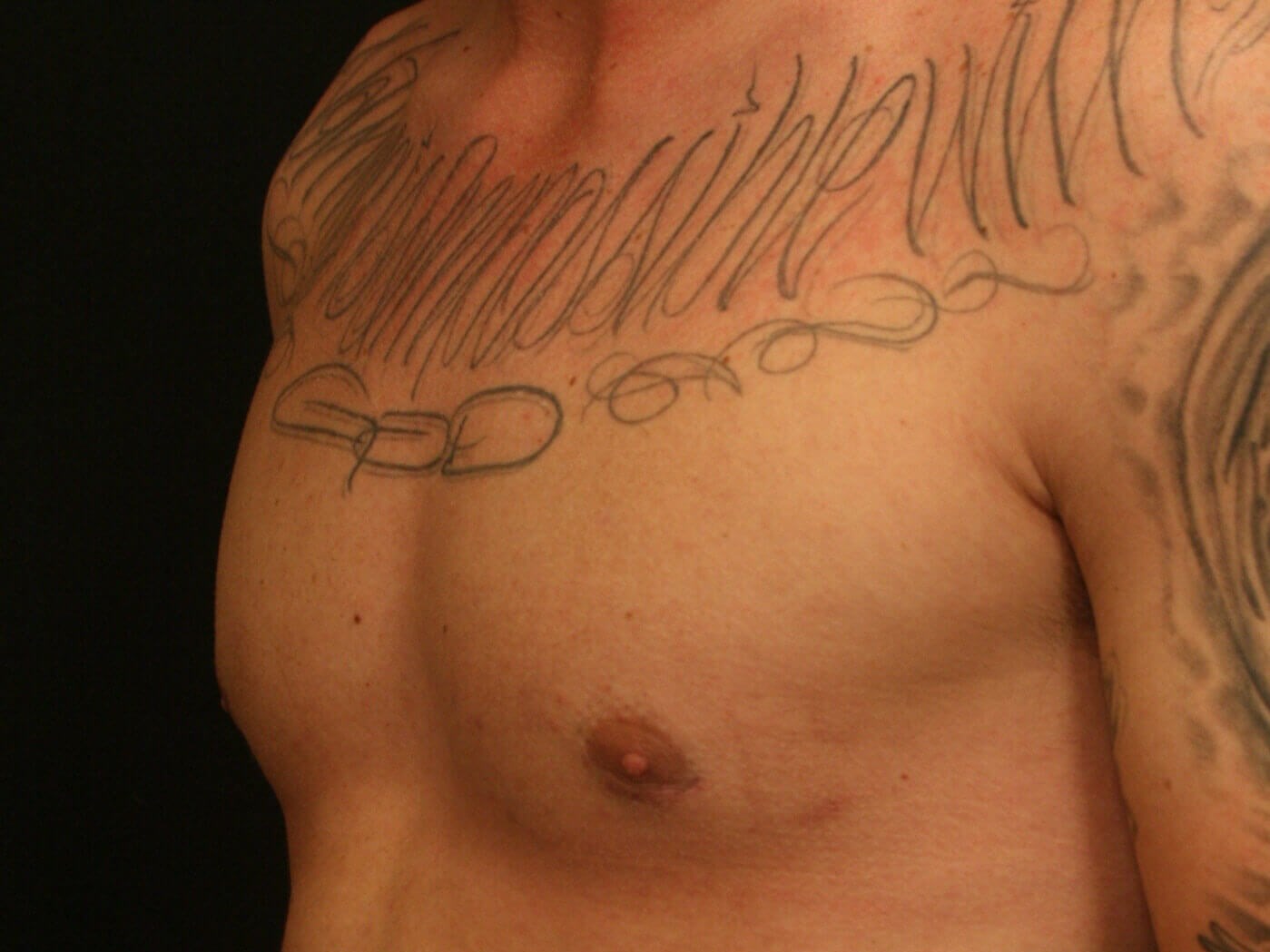 Gynecomastia Before and After After