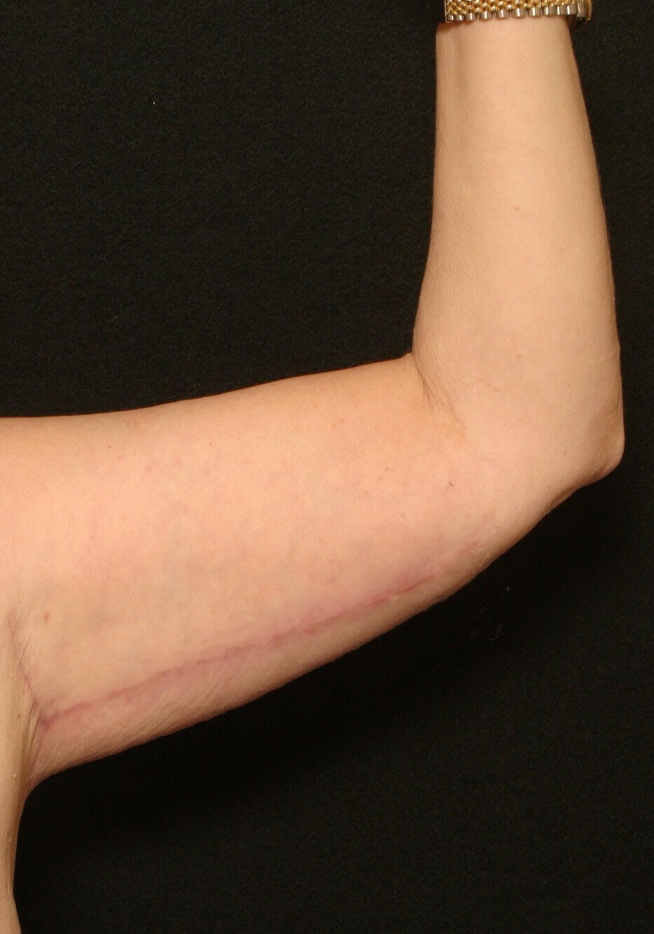 Arm Lift Before and After After