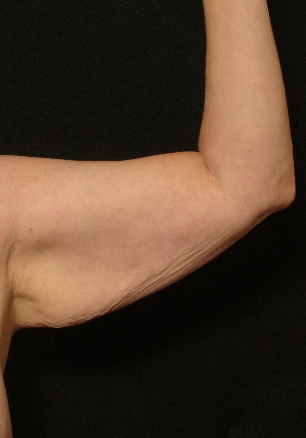 Arm Lift Before and After Before