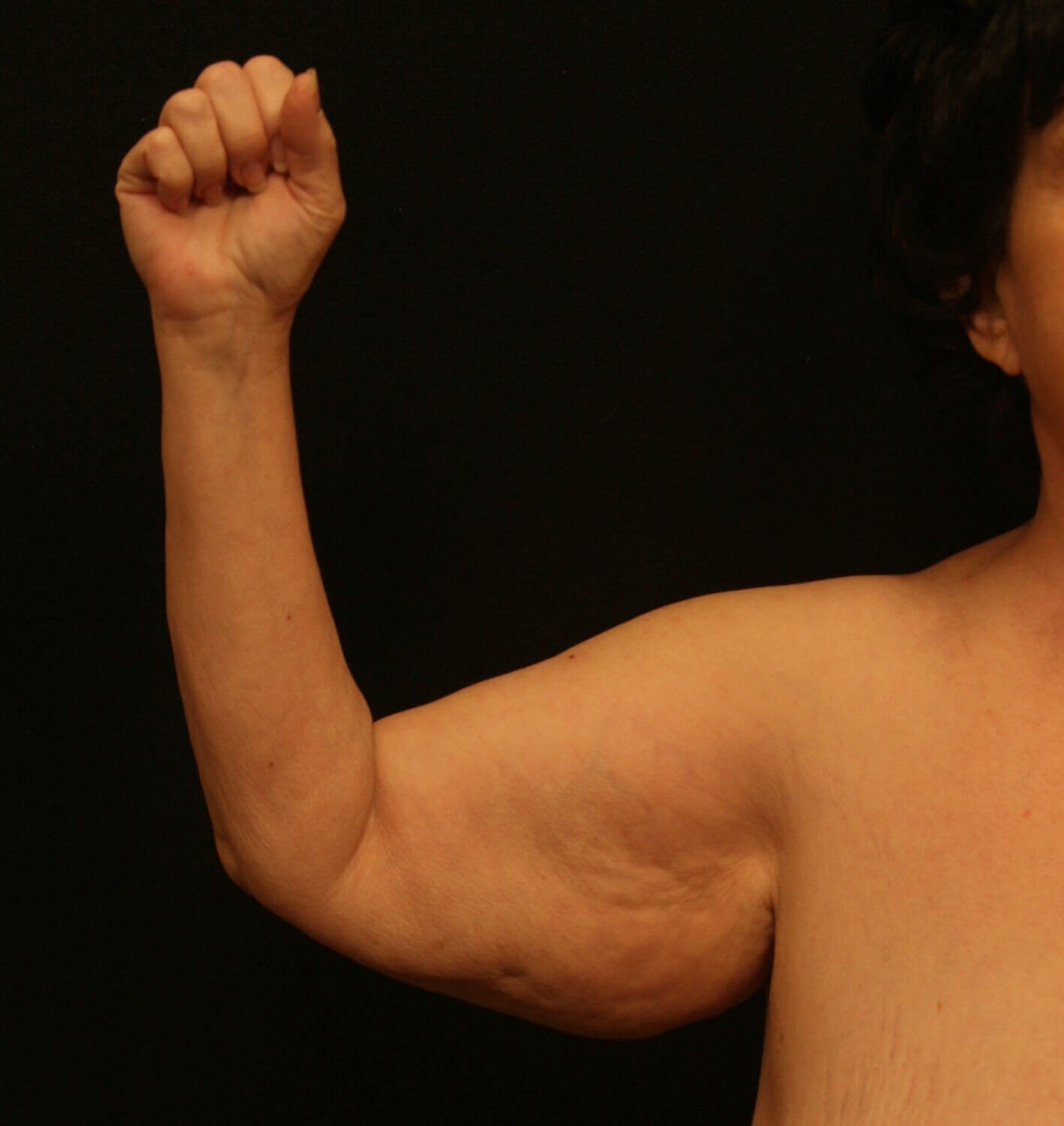 Arm Lift Before and After Before