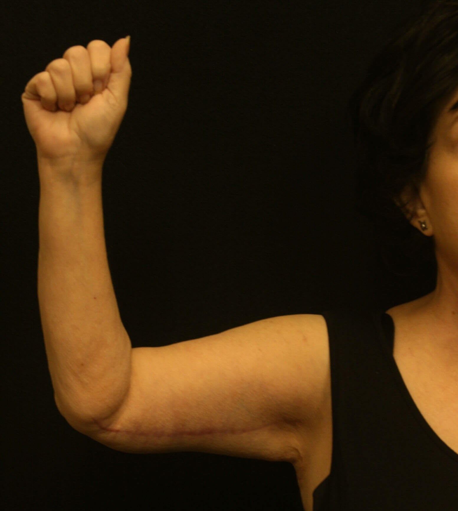 Arm Lift Before and After After