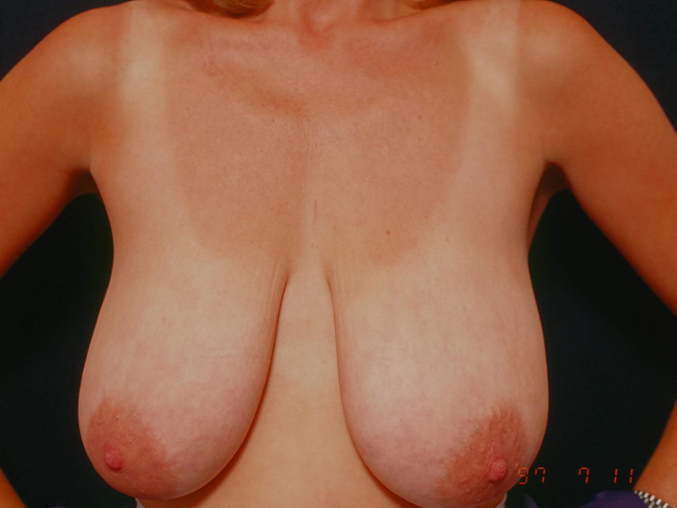 Breast Lift Before and After Before