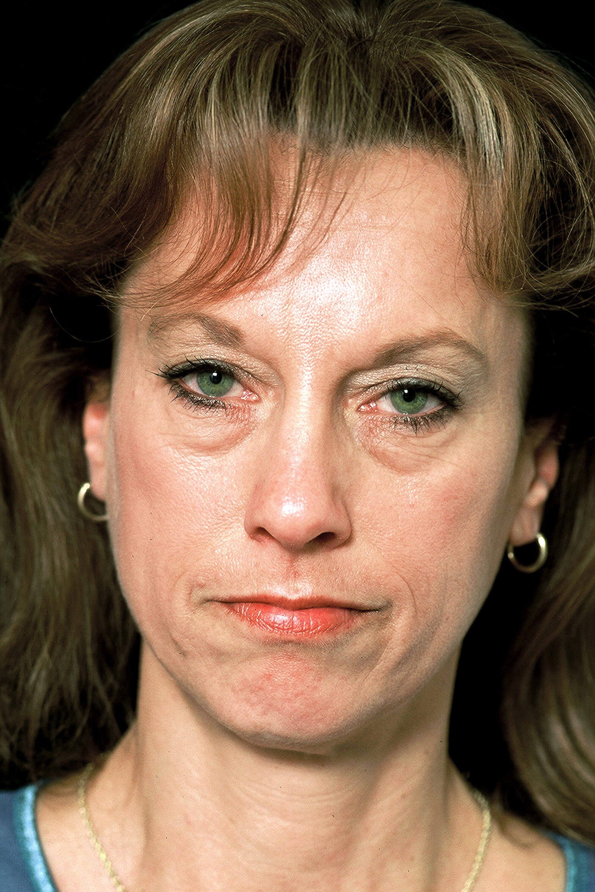 Forehead Lift Before and After Before