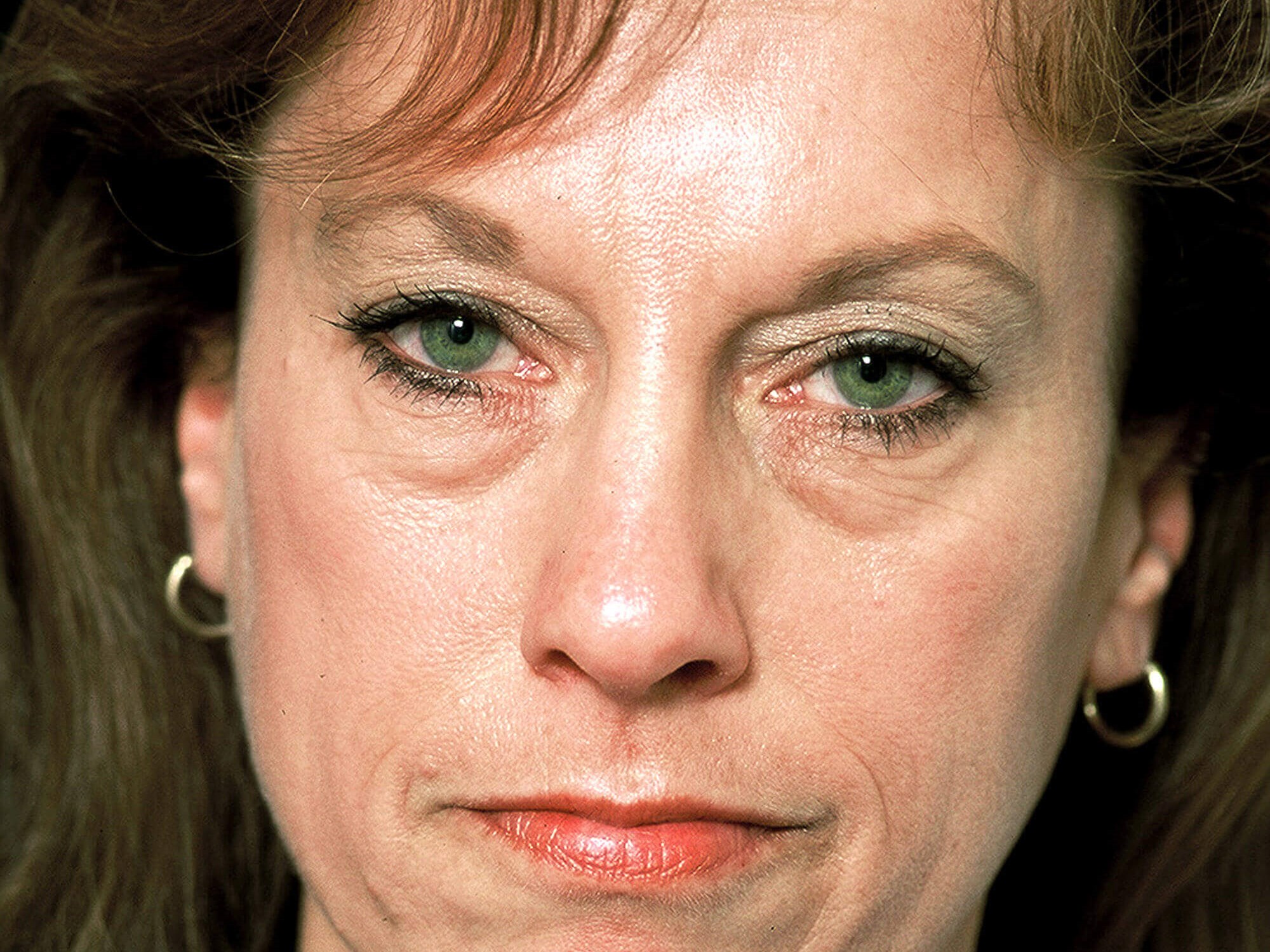 Forehead Lift Before and After Before