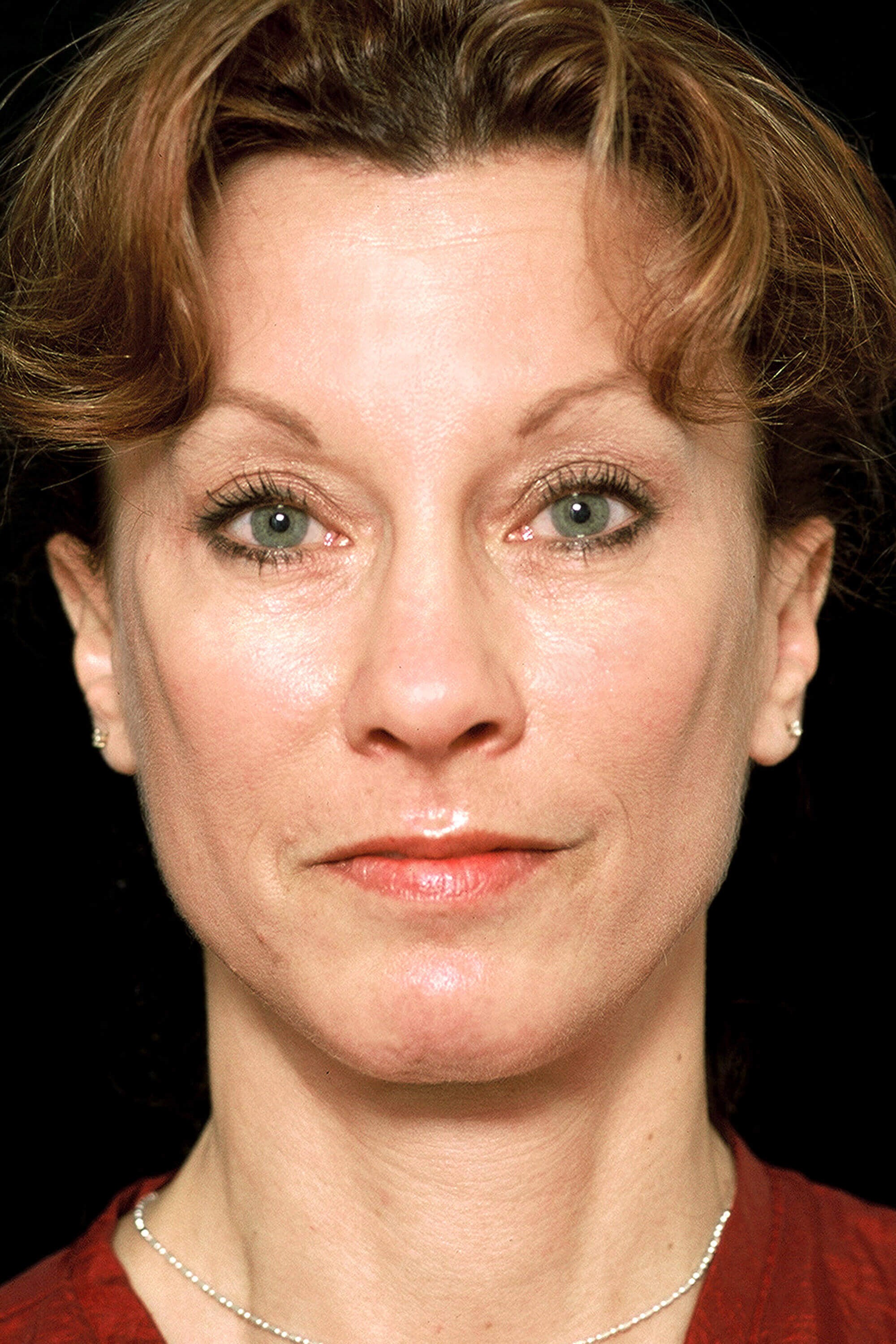 Forehead Lift Before and After After