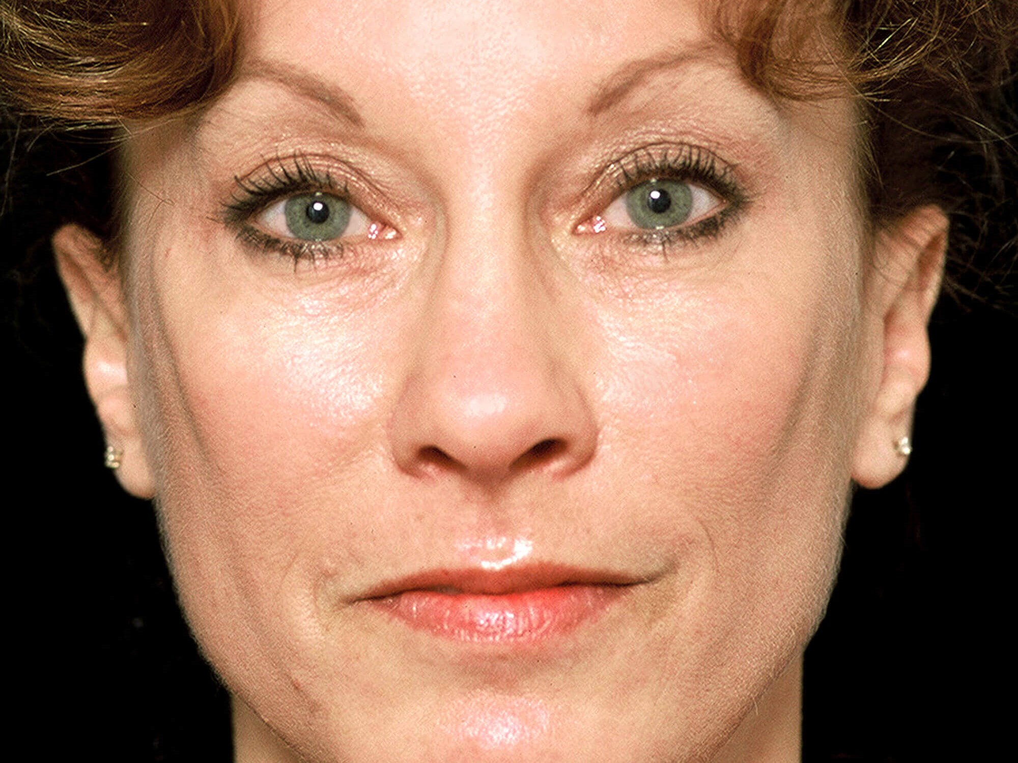 Forehead Lift Before and After After