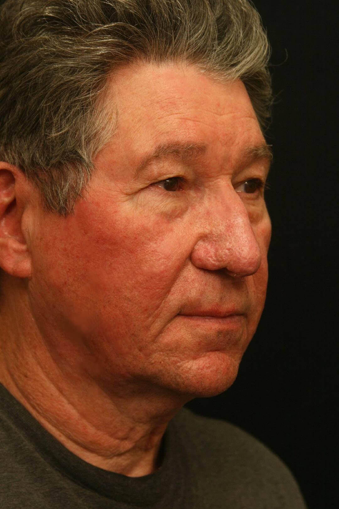 Treatment of Rhinophyma After