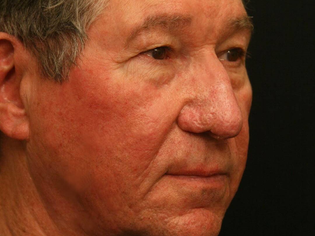 Treatment of Rhinophyma After