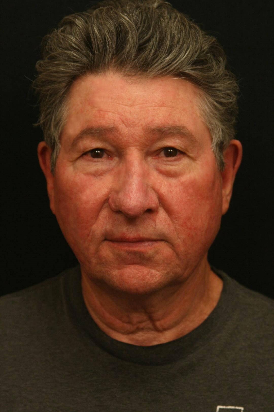 Treatment of Rhinophyma After