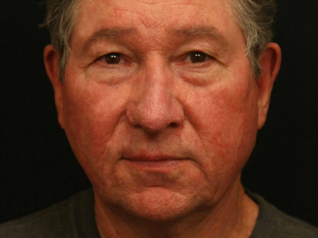 Treatment of Rhinophyma After