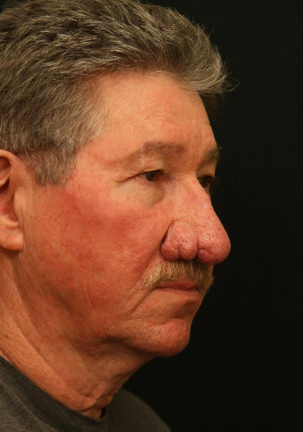 Treatment of Rhinophyma Before