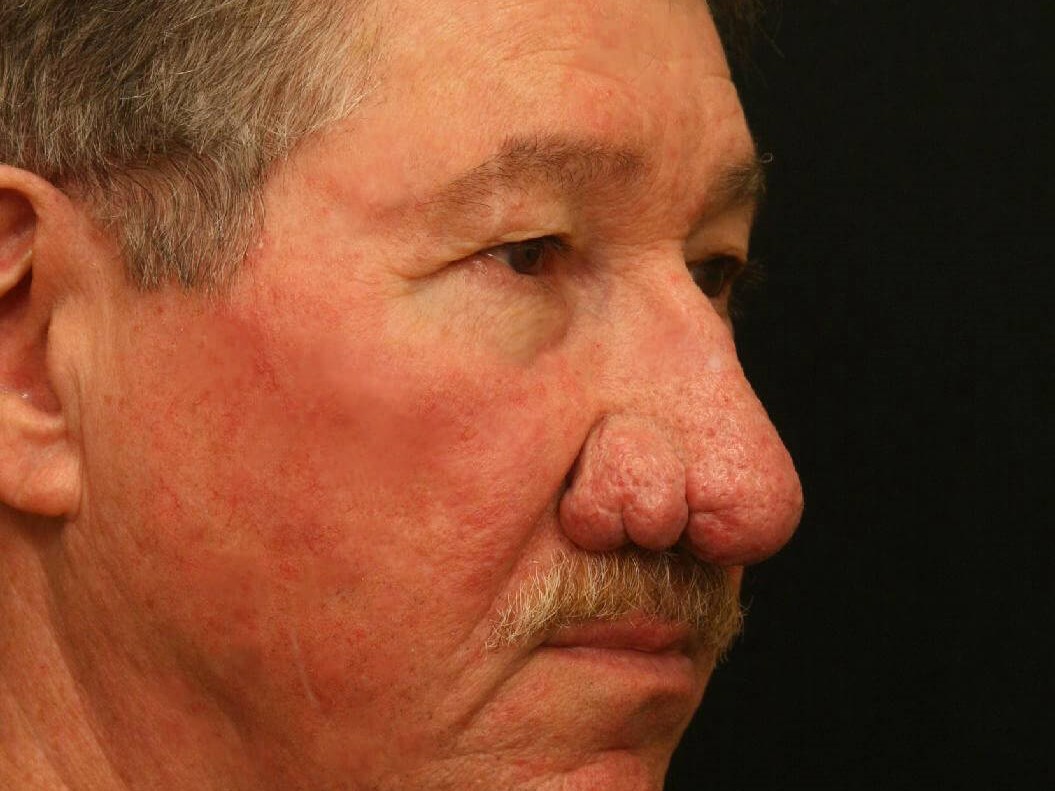 Treatment of Rhinophyma Before