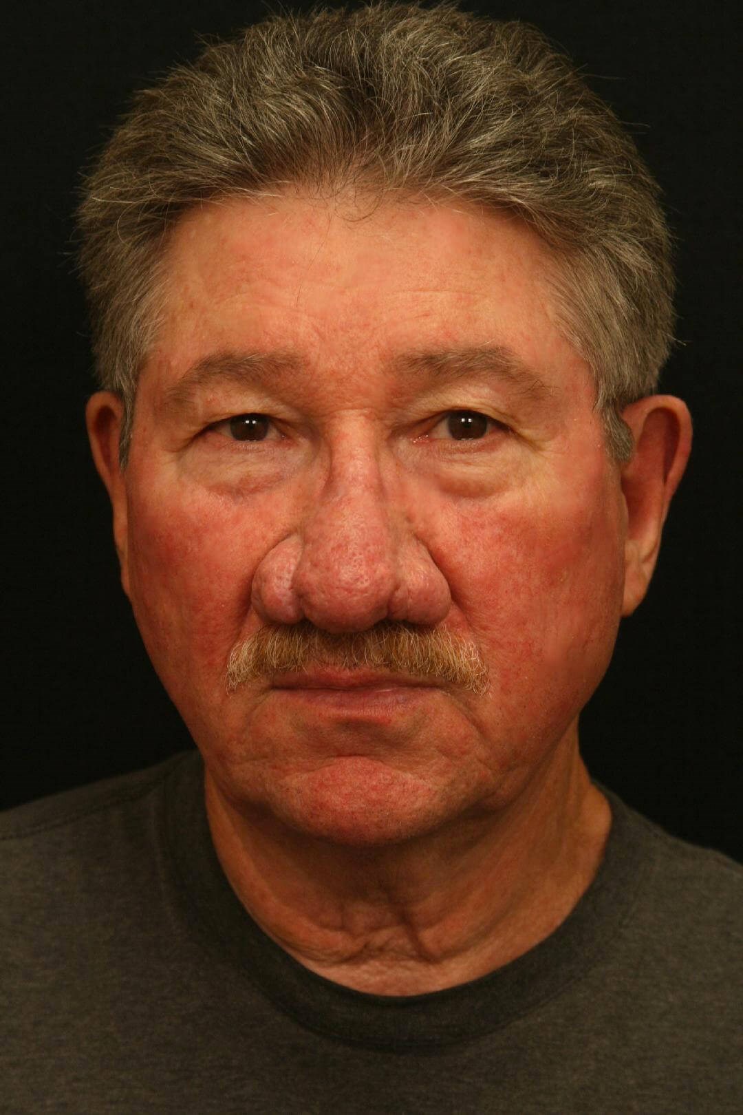 Treatment of Rhinophyma Before