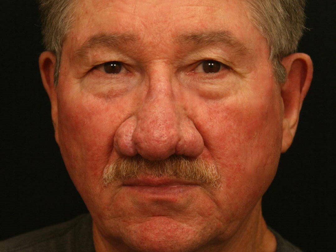 Treatment of Rhinophyma Before