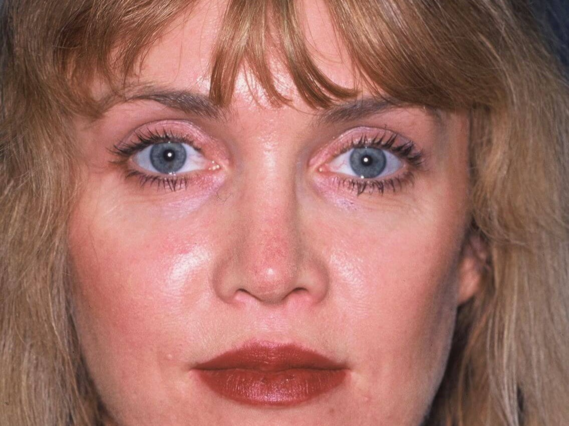 Rhinoplasty Before and After After