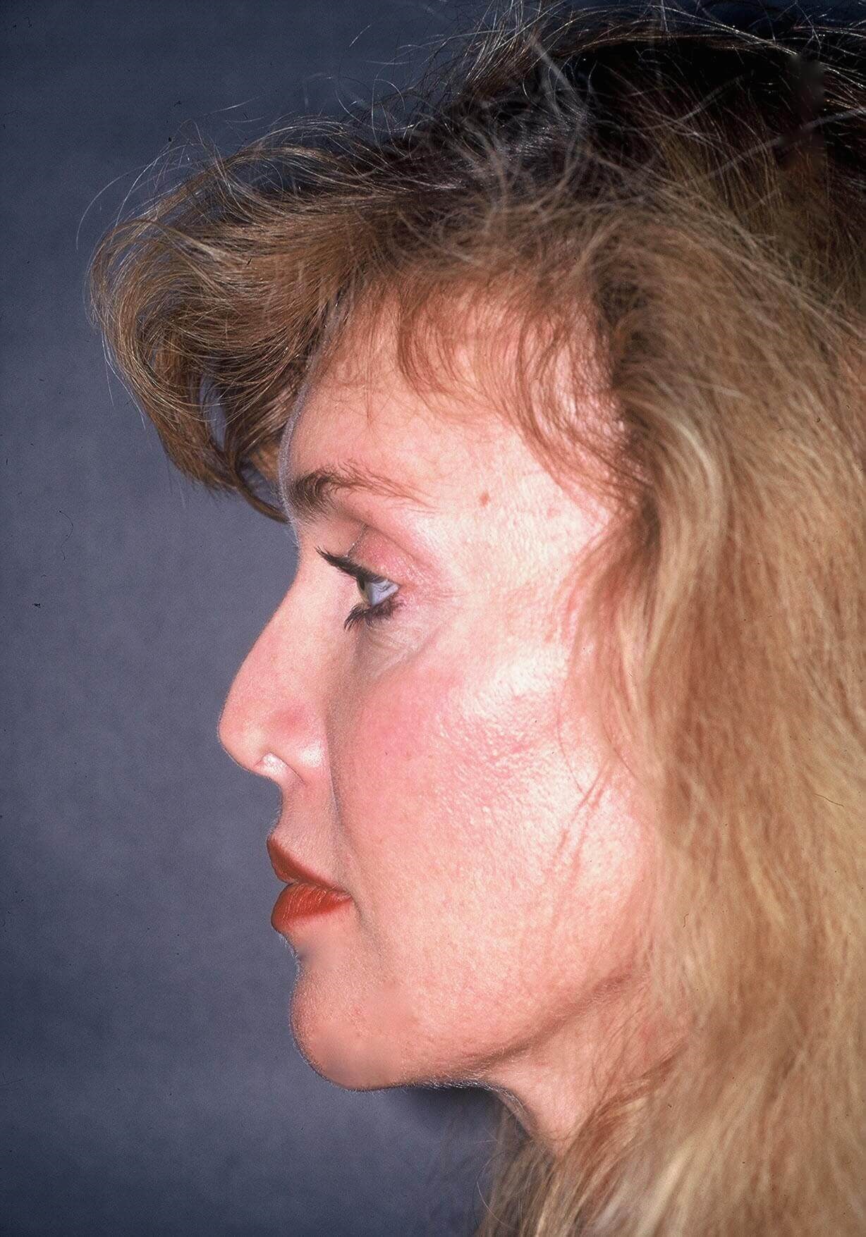 Rhinoplasty Before and After Before