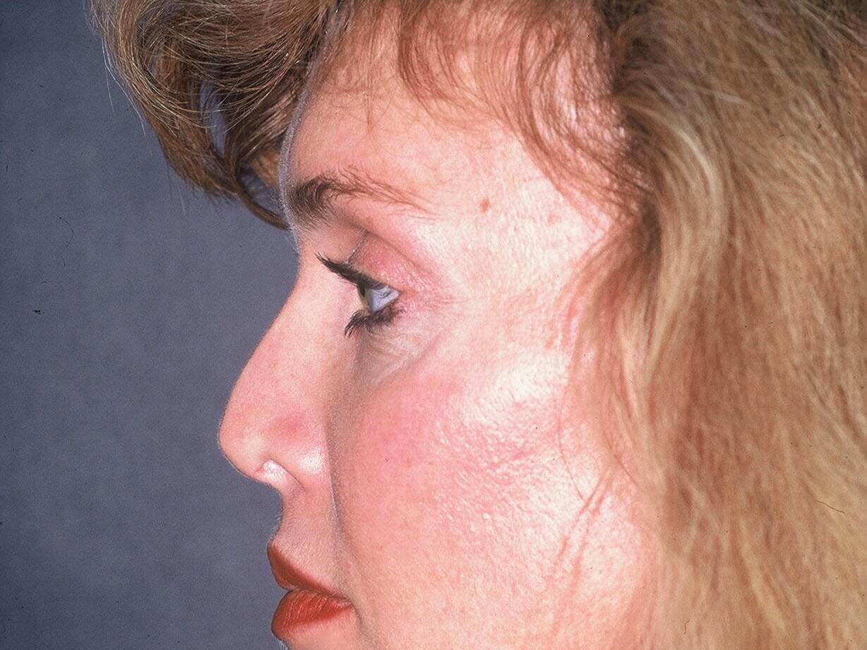 Rhinoplasty Before and After Before