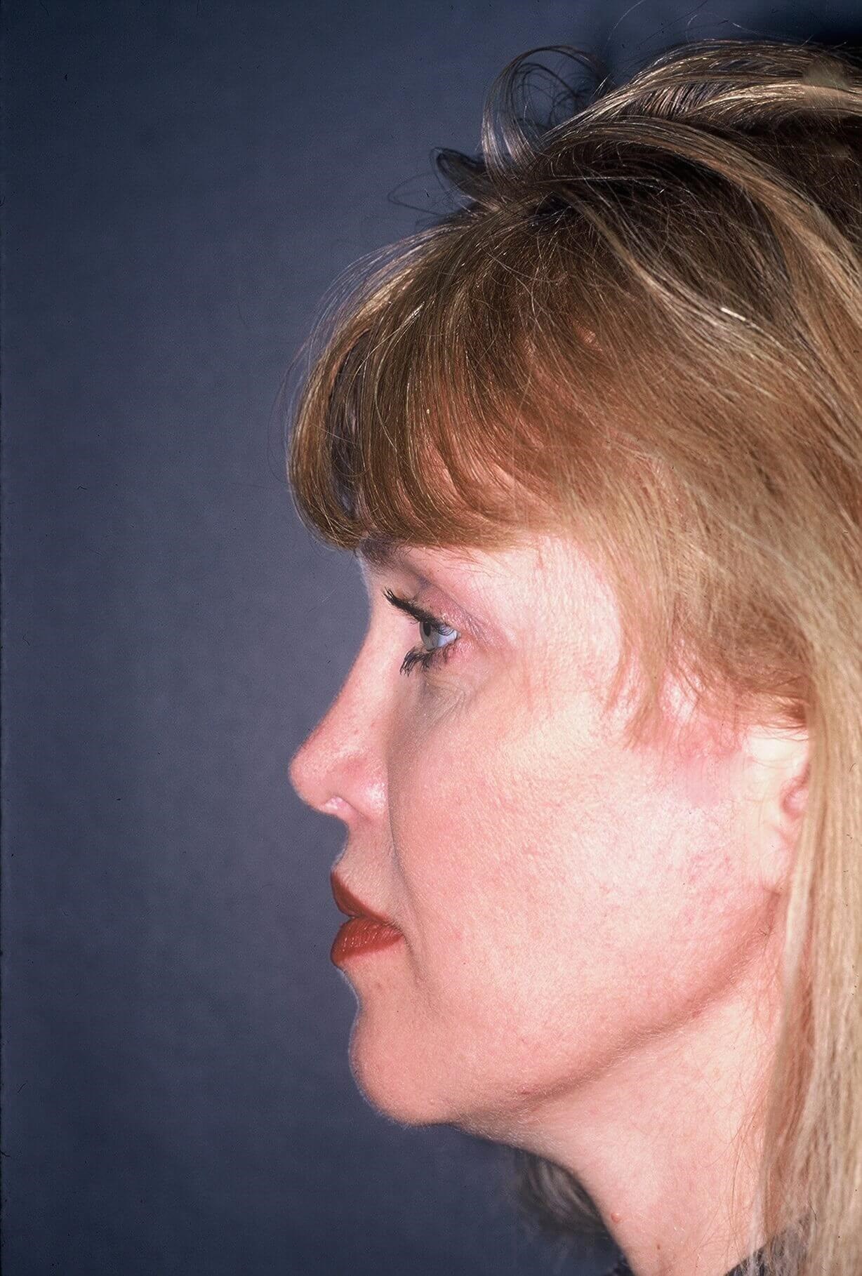 Rhinoplasty Before and After After