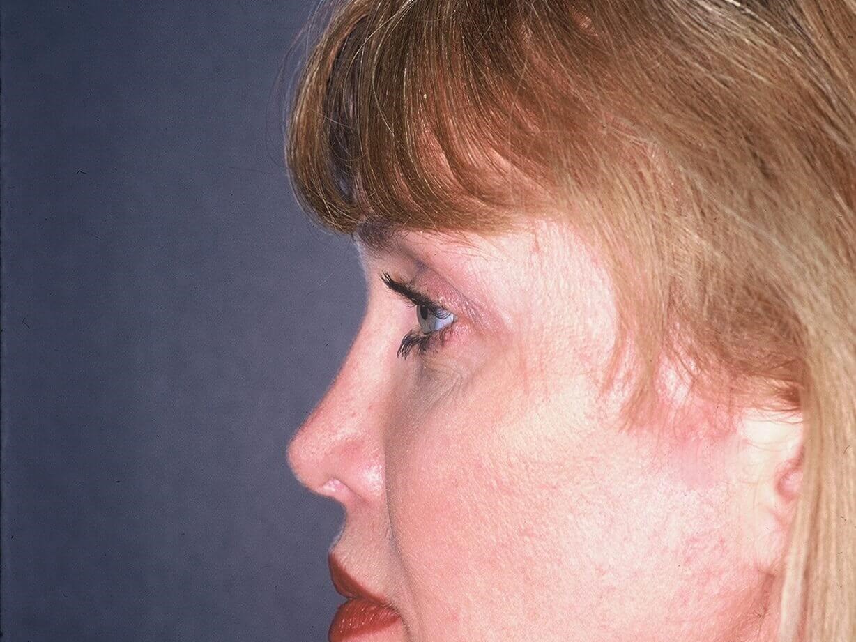 Rhinoplasty Before and After After