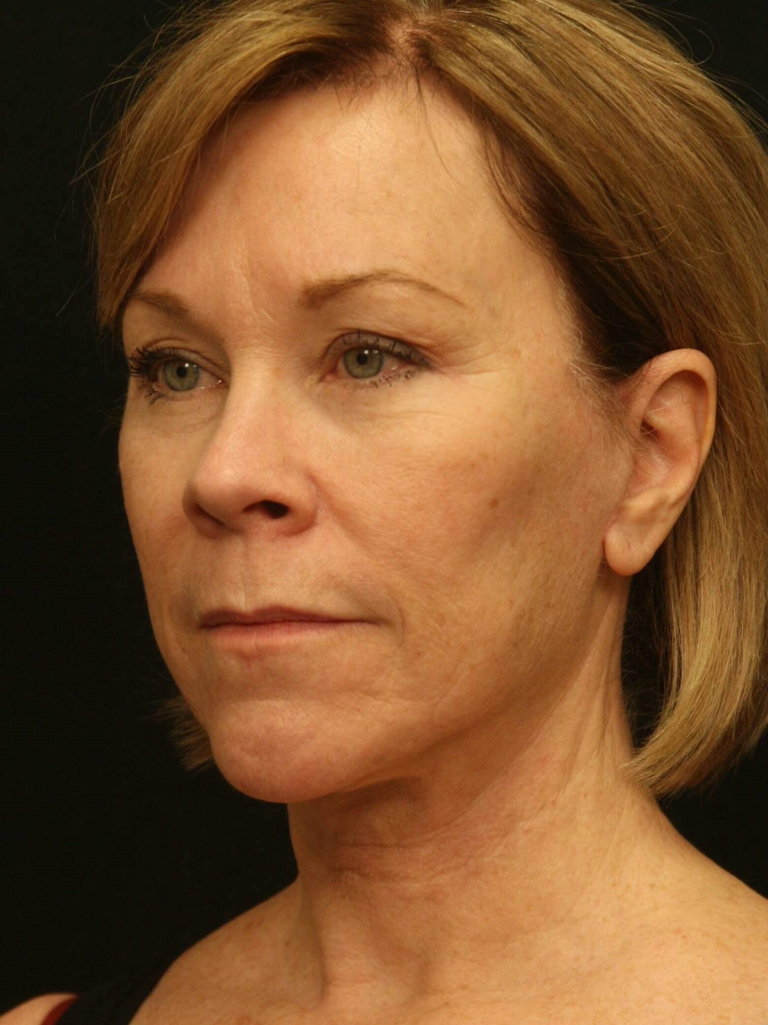 Facelift Before and After After