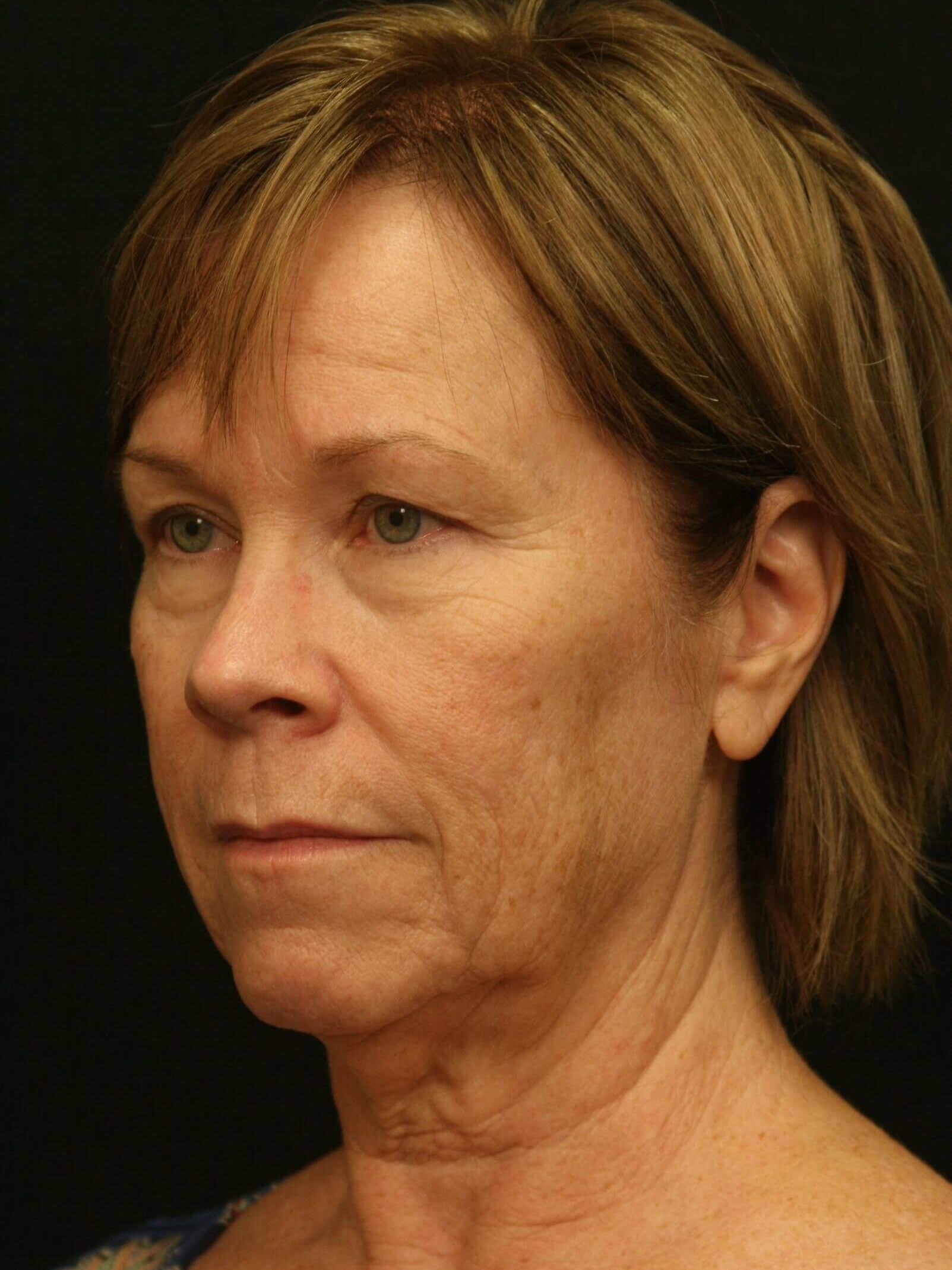 Facelift Before and After Before