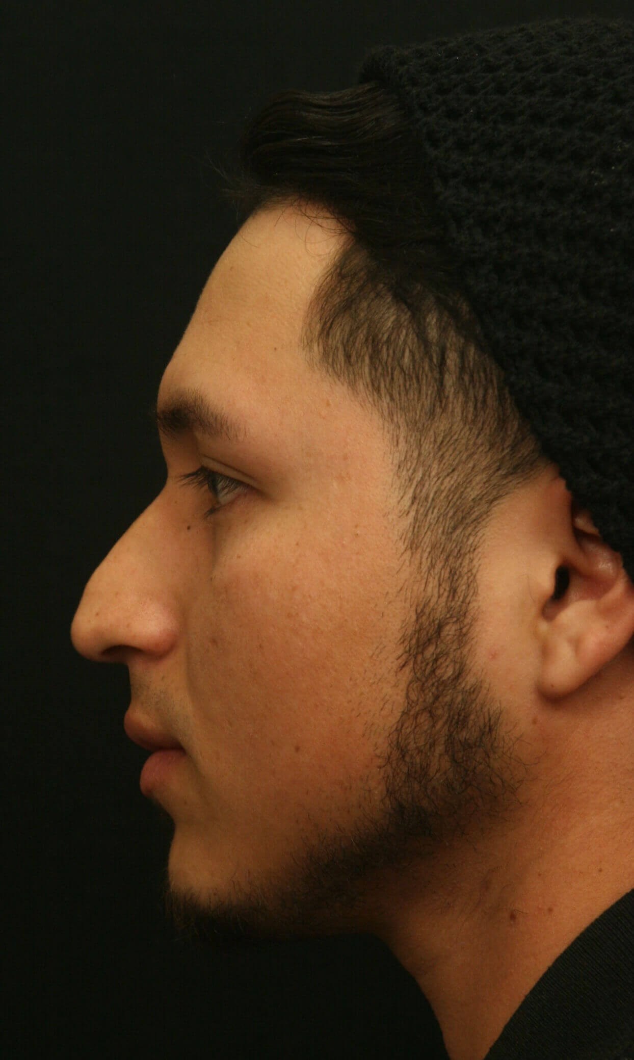 Rhinoplasty Before and After Before