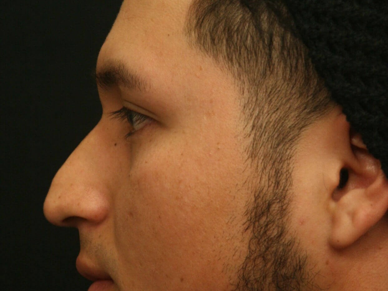 Rhinoplasty Before and After Before