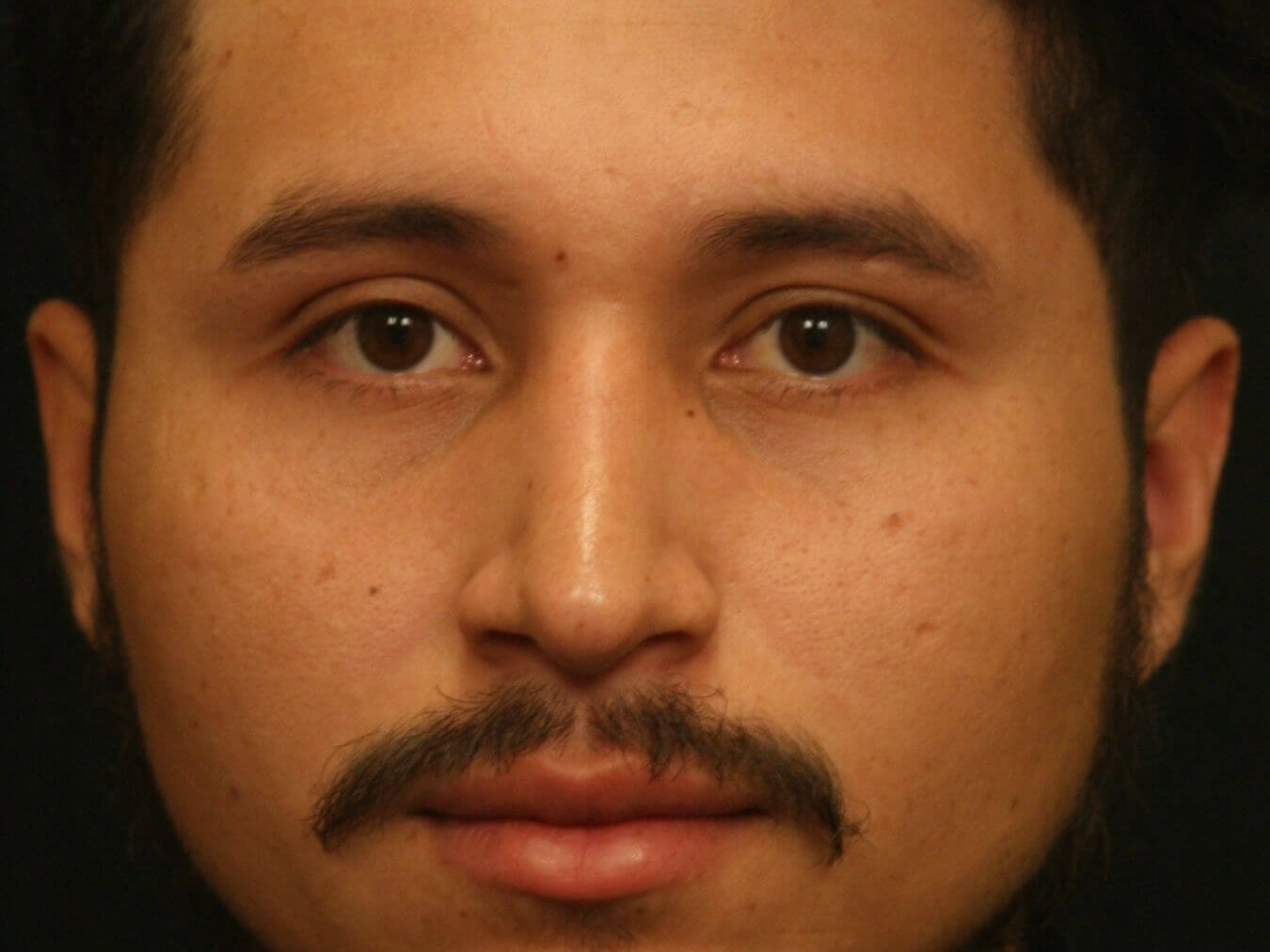 Rhinoplasty Before and After After