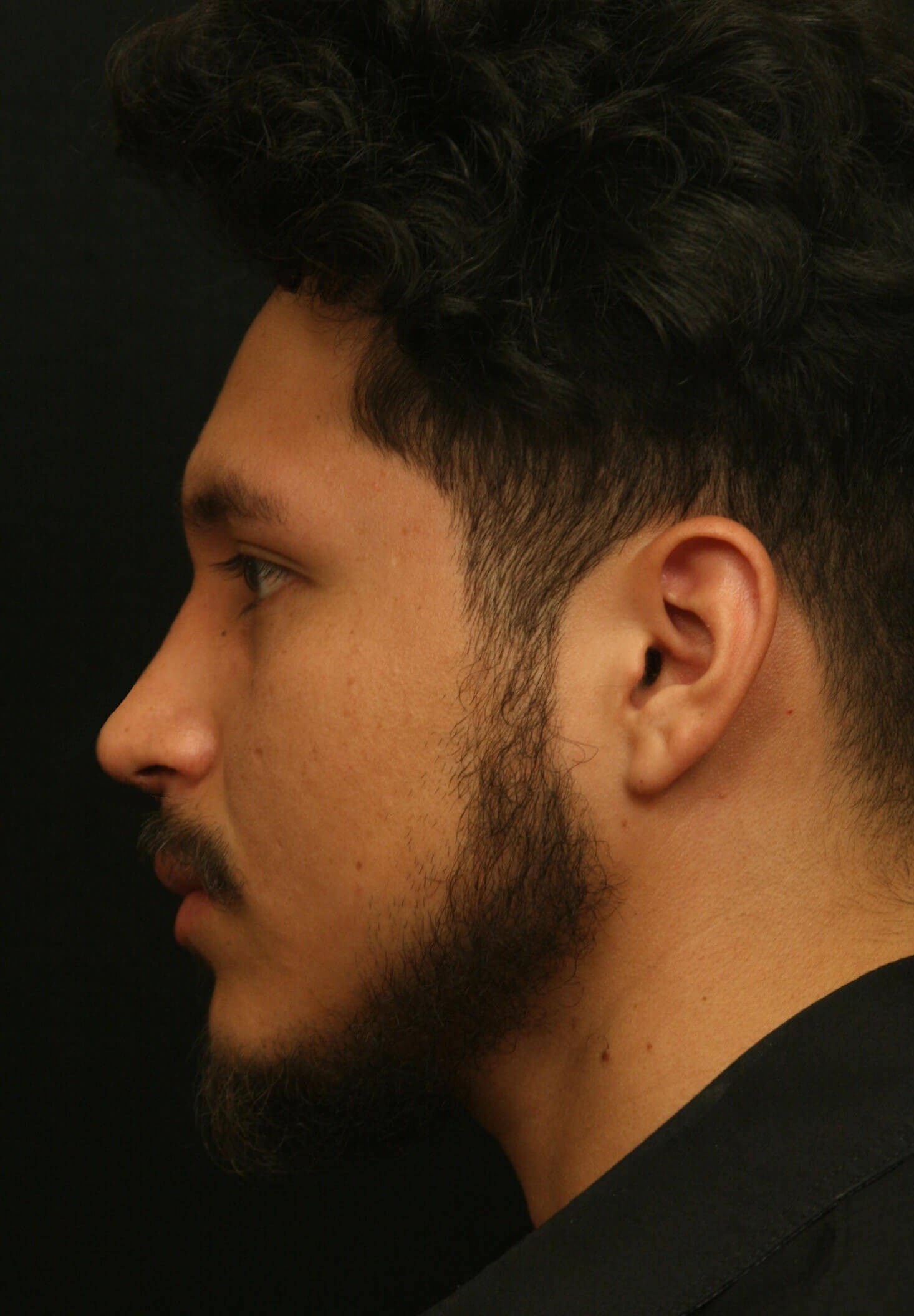 Rhinoplasty Before and After After