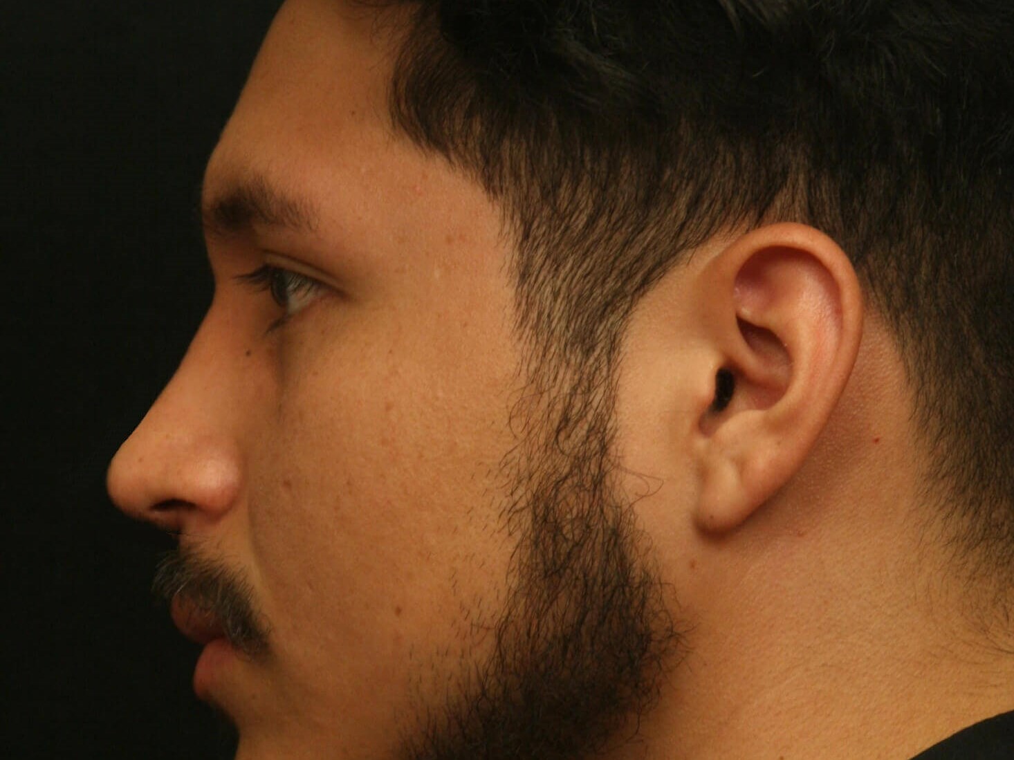 Rhinoplasty Before and After After