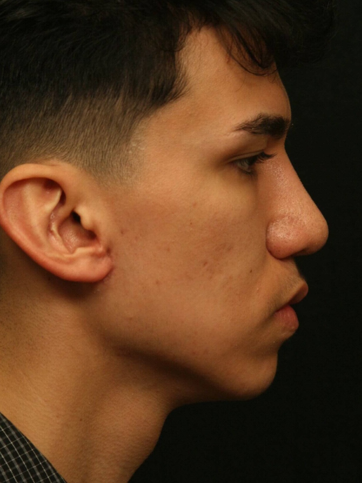 Rhinoplasty Before and After After
