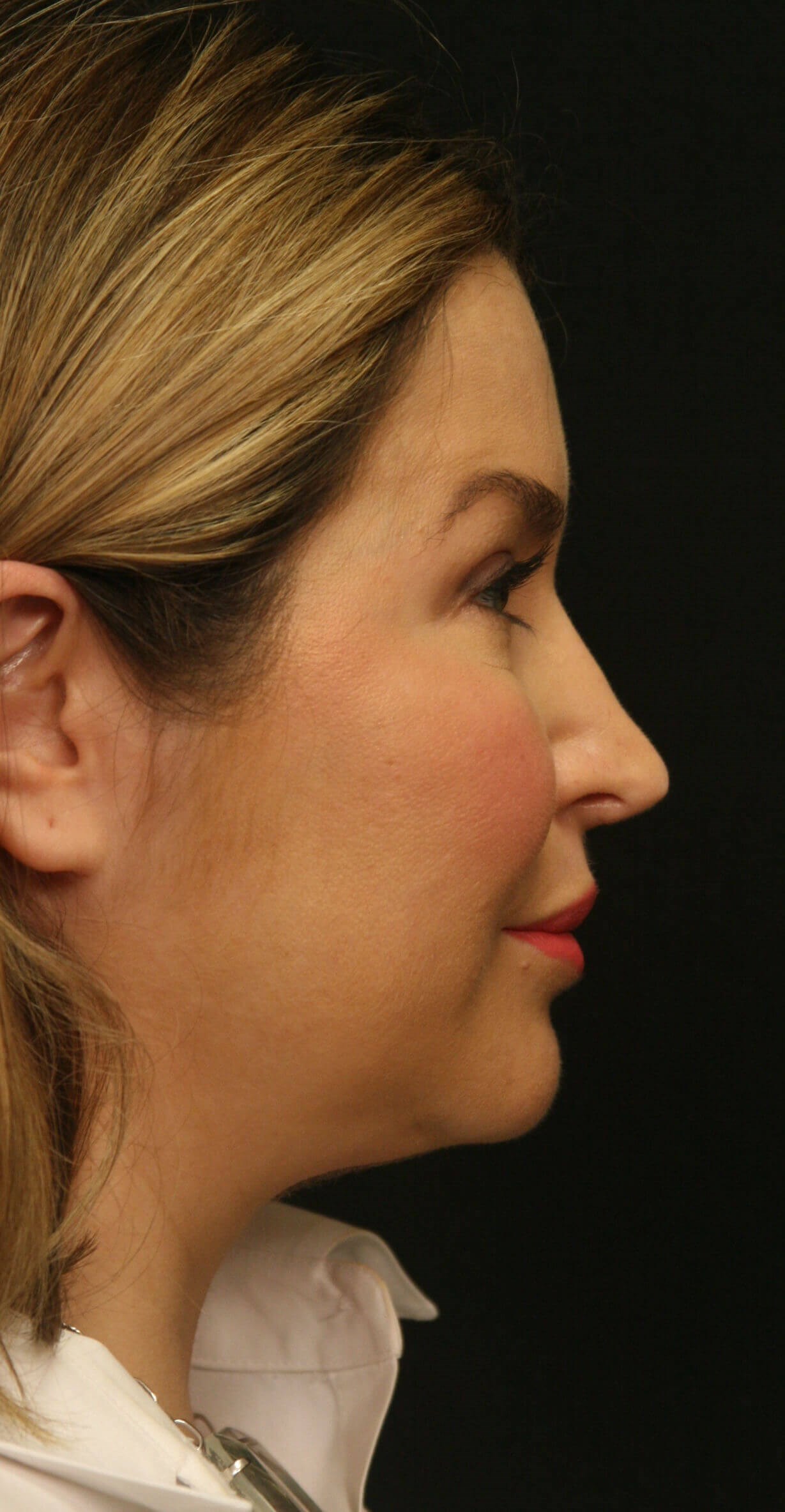 Revision Rhinoplasty Results Before