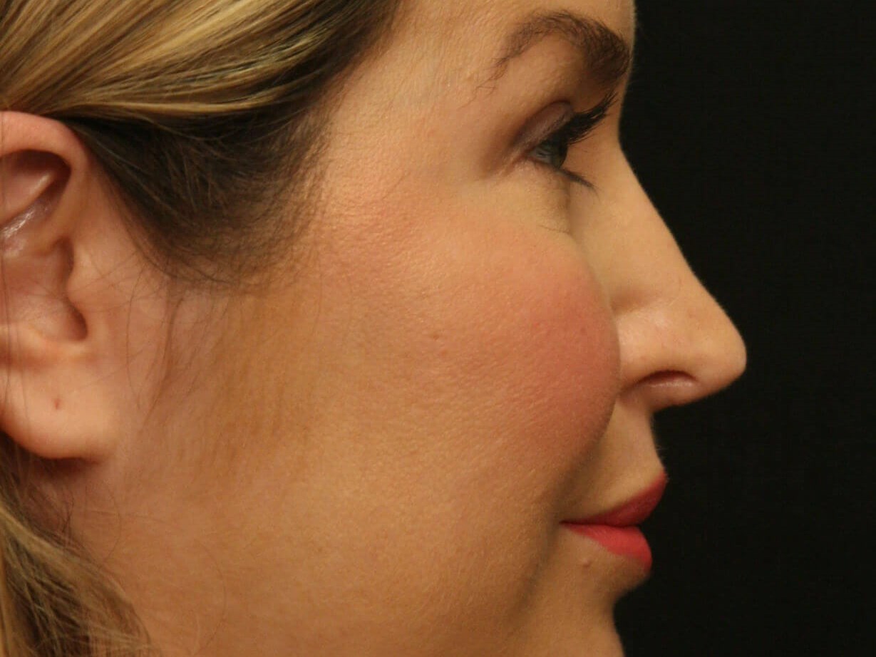 Revision Rhinoplasty Results Before