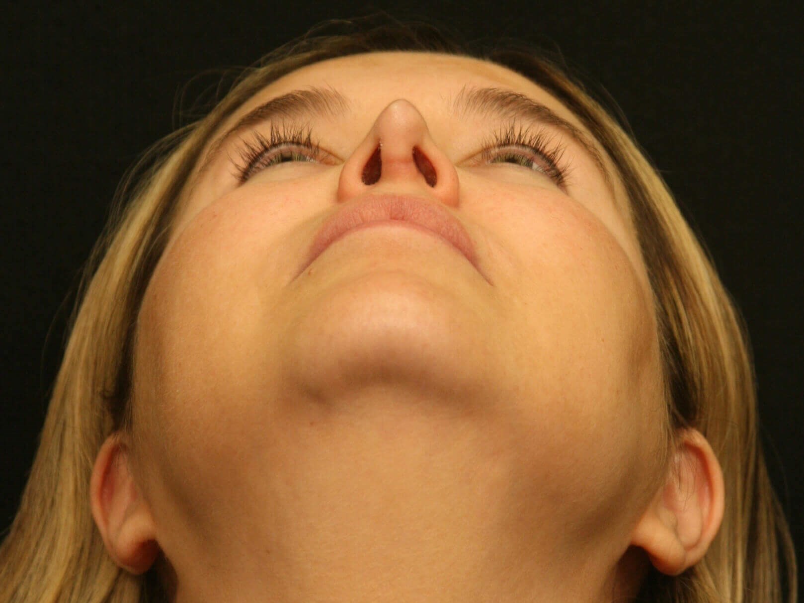 Revision Rhinoplasty Results Before