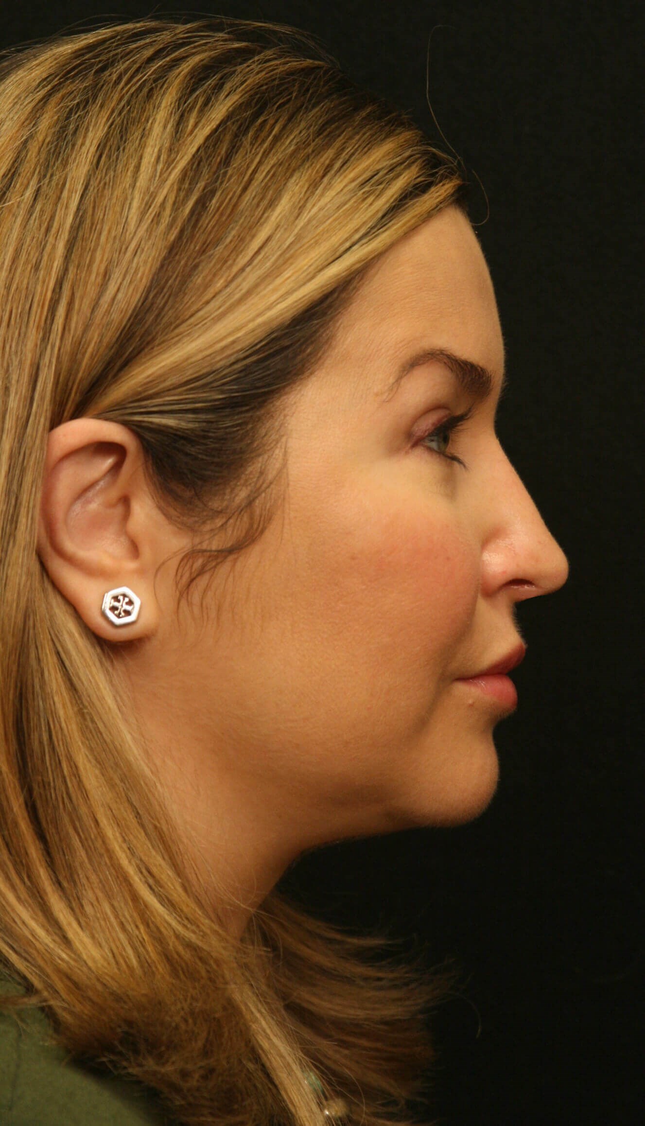 Revision Rhinoplasty Results After