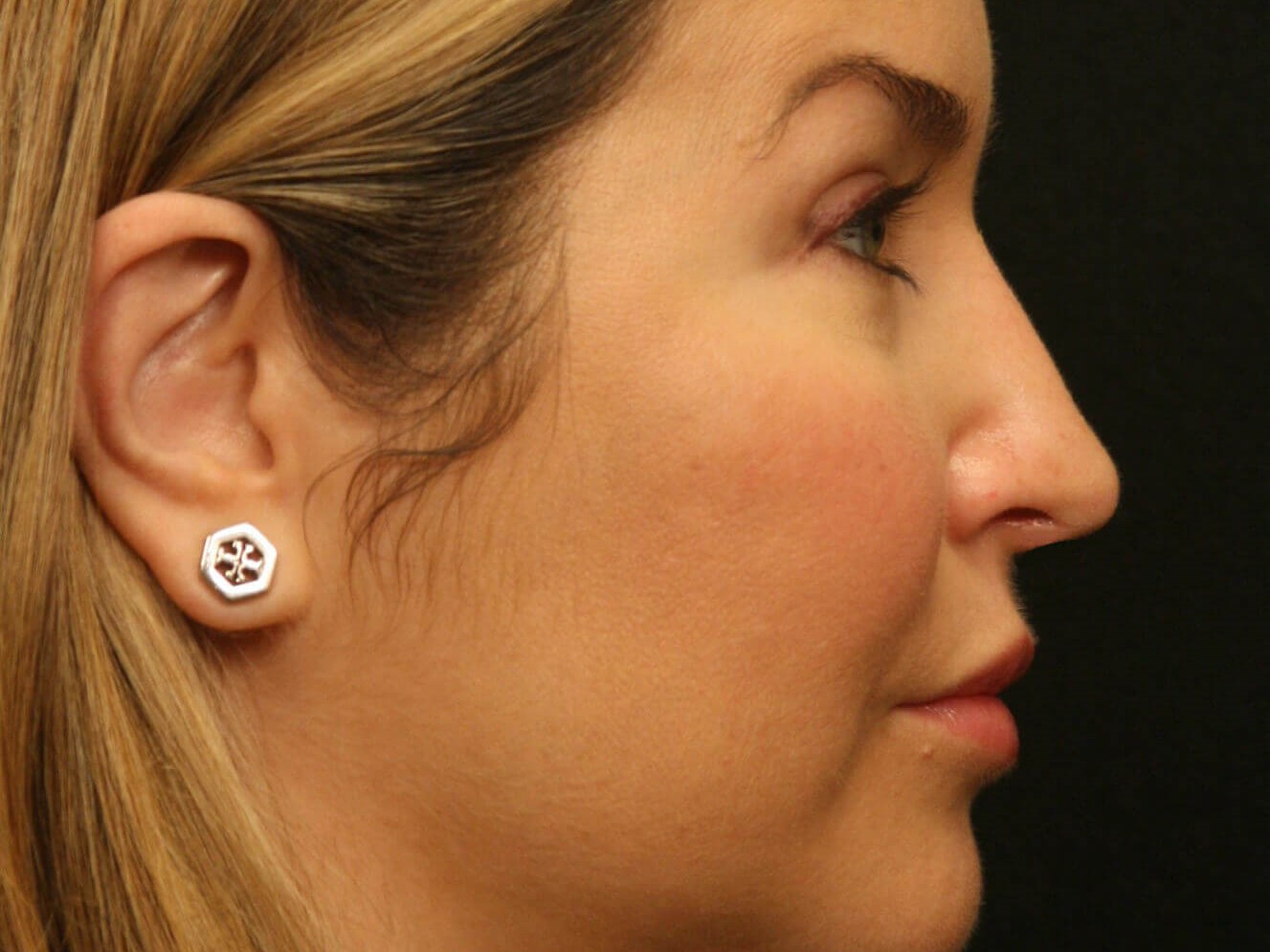 Revision Rhinoplasty Results After