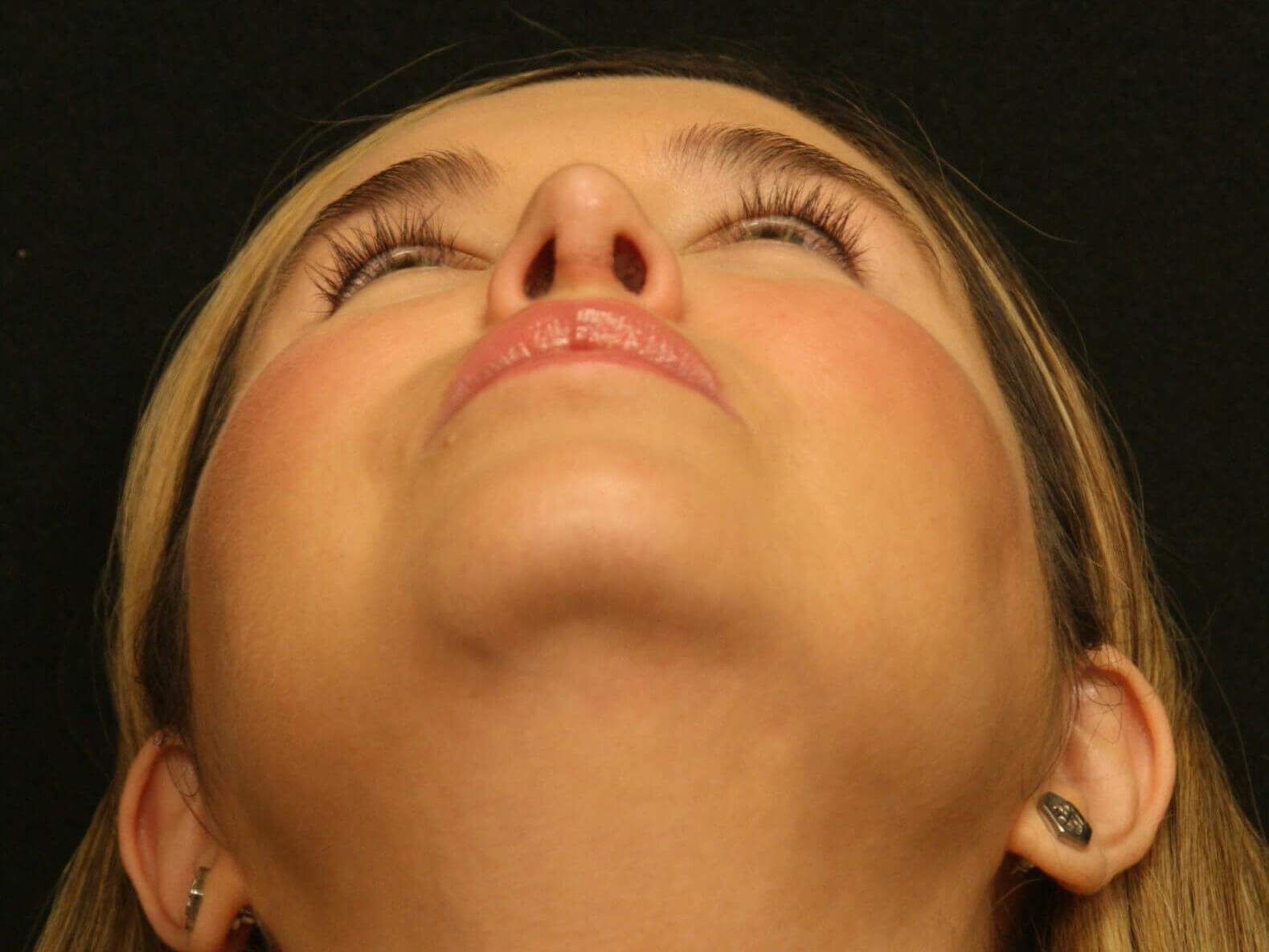 Revision Rhinoplasty Results After