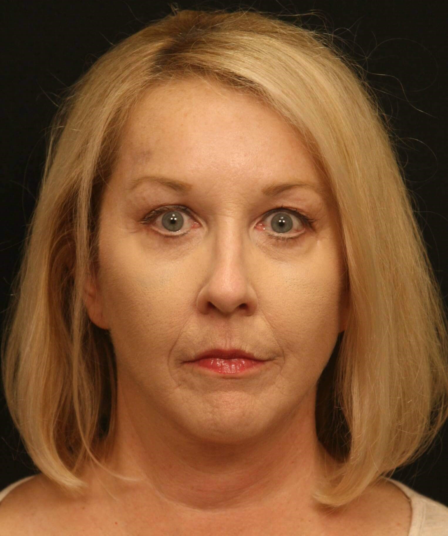 Facelift Before and After After