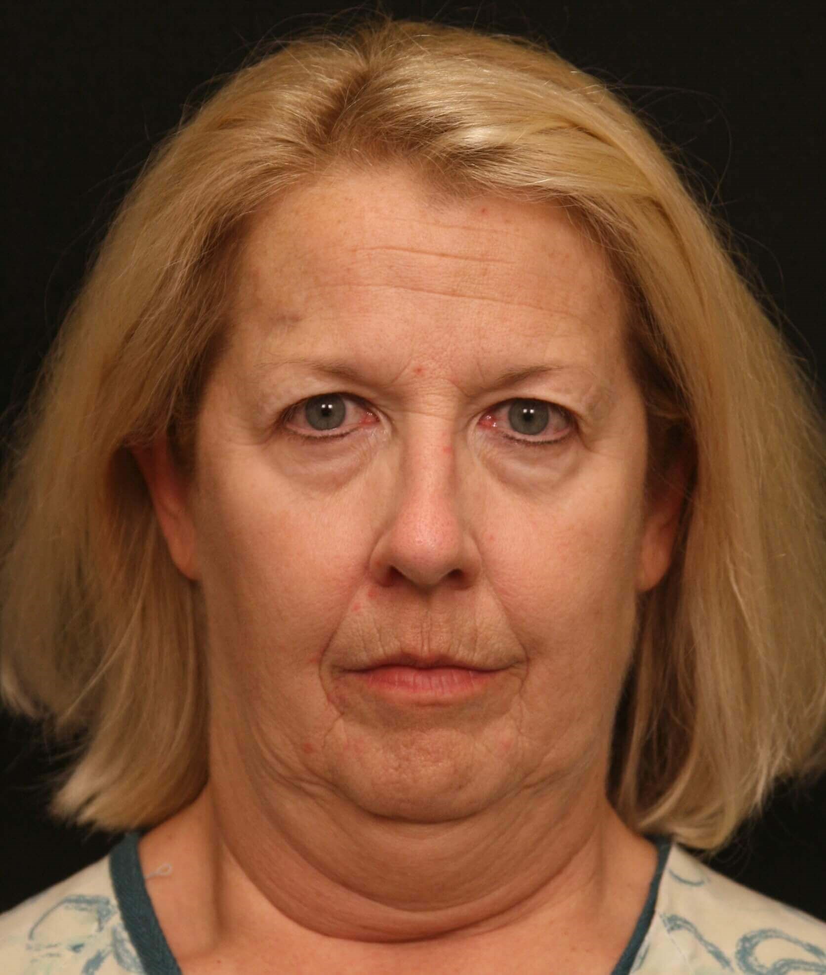 Facelift Before and After Before