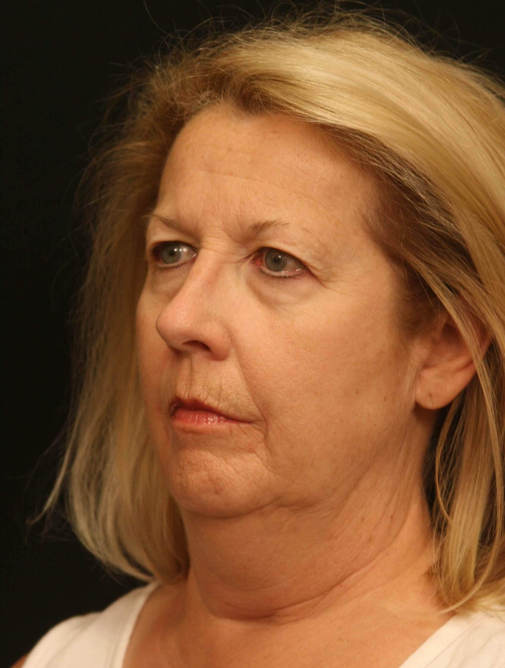 Facelift Before and After Before