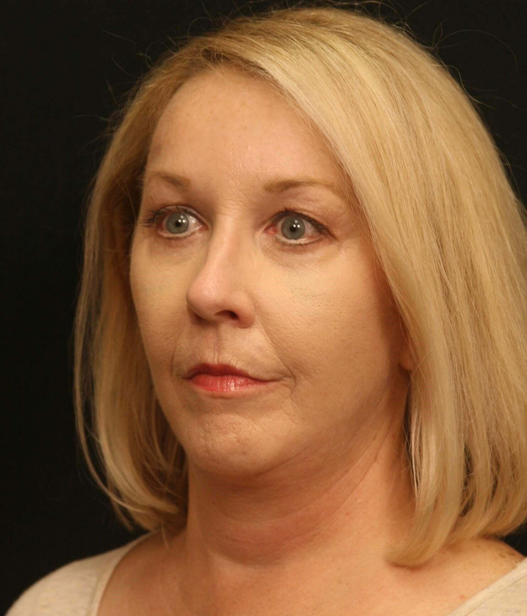 Facelift Before and After After