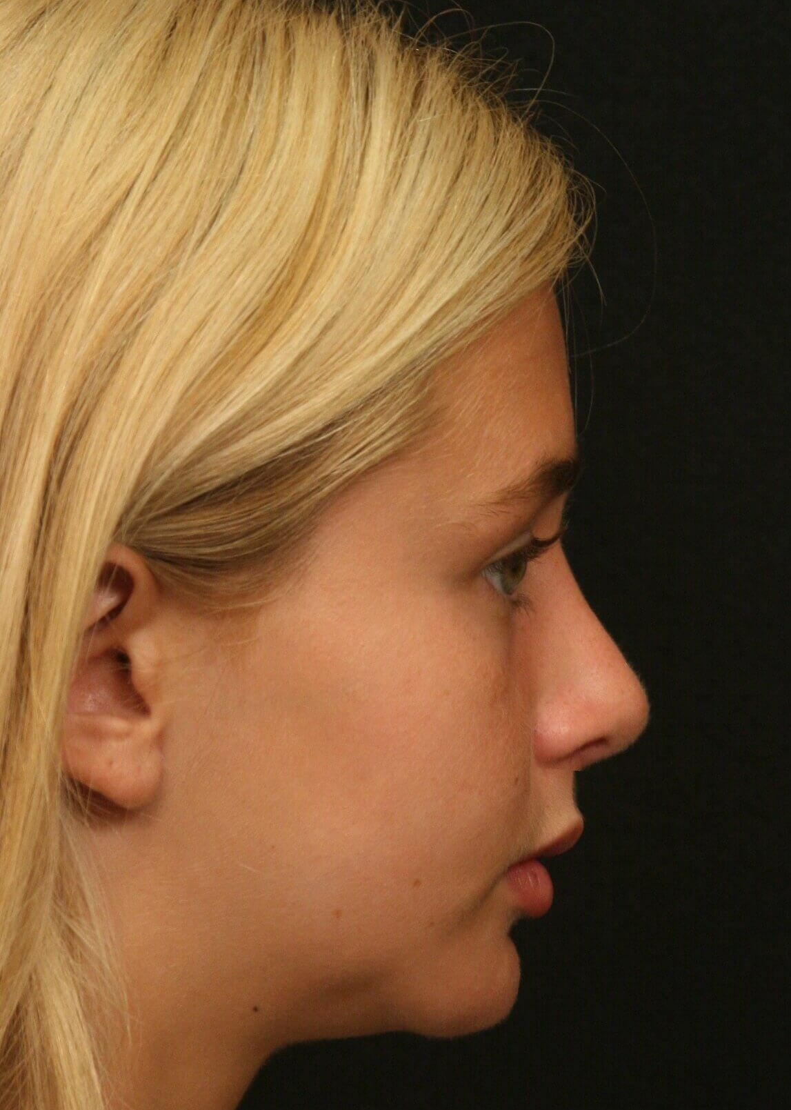 Rhinoplasty Before and After After