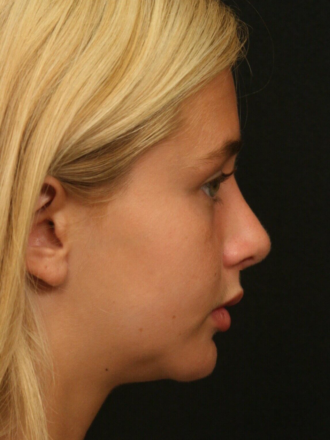 Rhinoplasty Before and After After