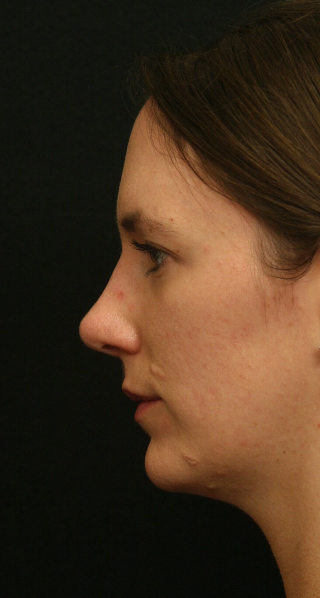 Rhinoplasty Before and After After