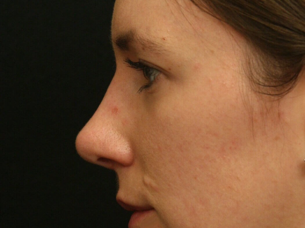 Rhinoplasty Before and After After