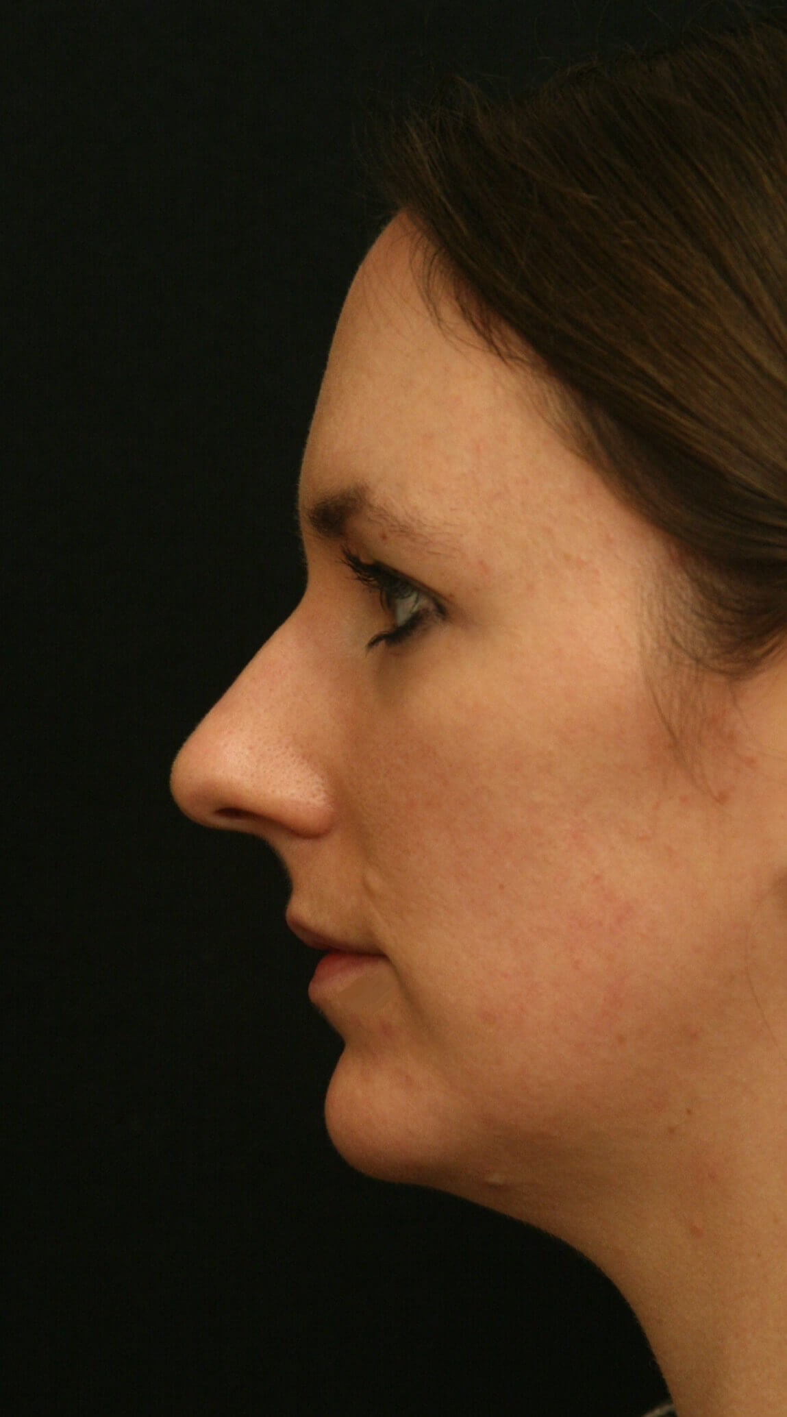 Rhinoplasty Before and After Before