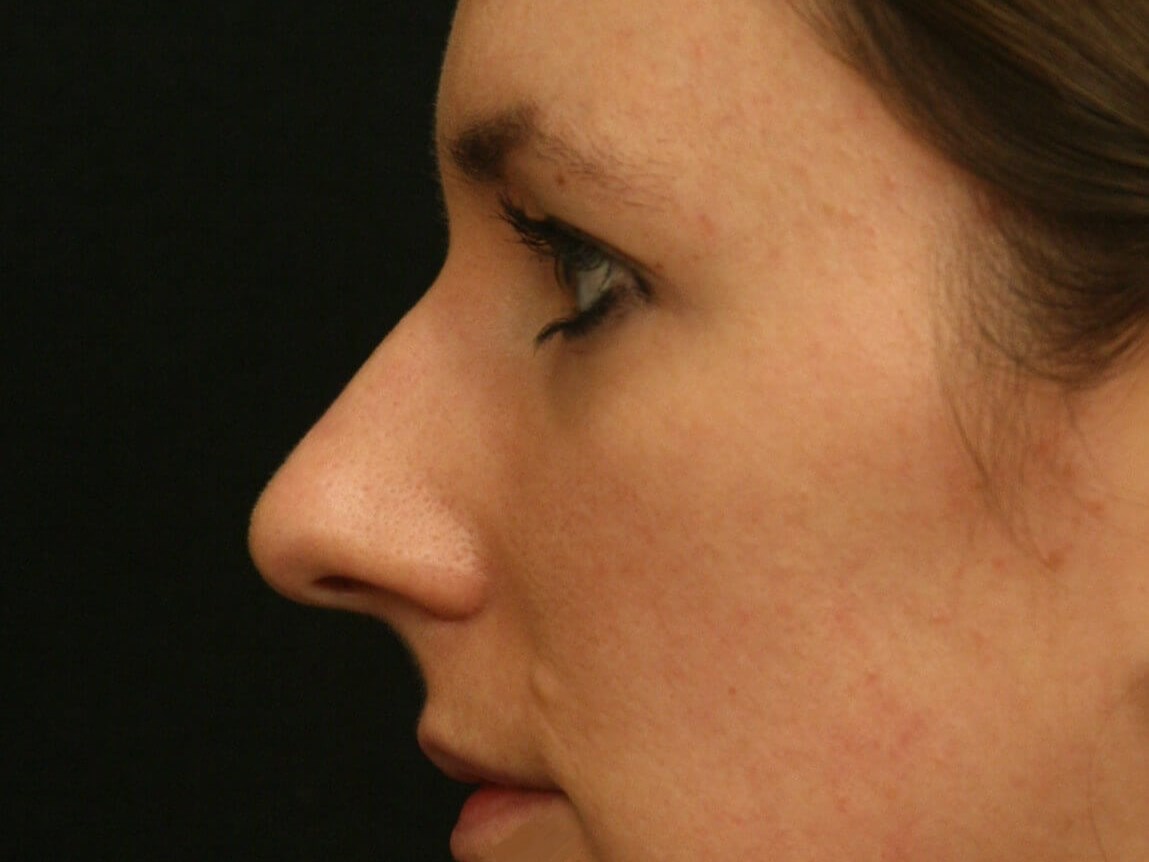 Rhinoplasty Before and After Before