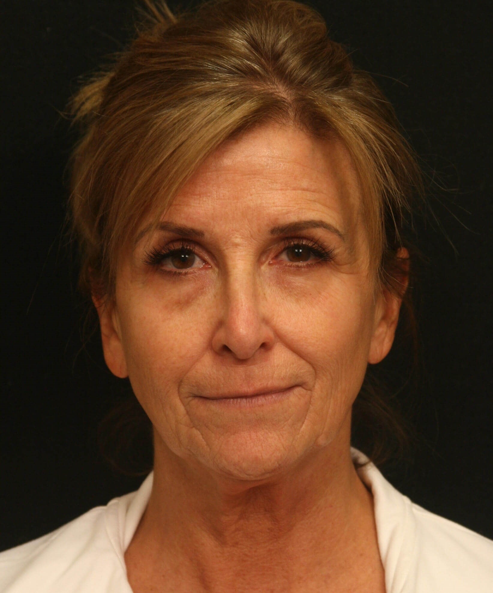 Facelift Before and After Before