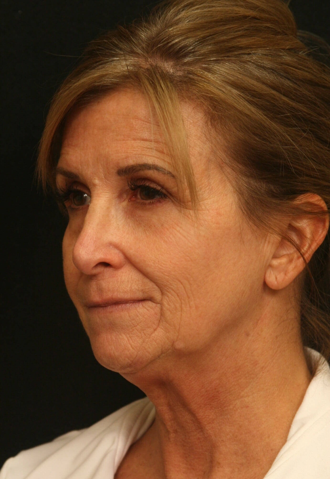 Facelift Before and After Before